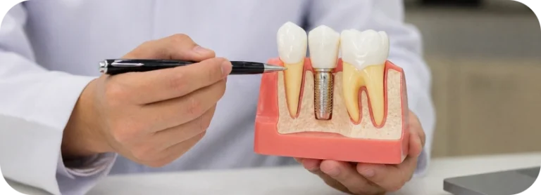 Jahnavee Dental Care | Dental Implants