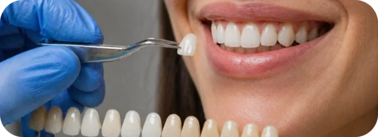 Jahnavee Dental Care | Dental Veneers
