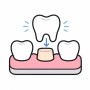Dental Crowns Bridges Final Placement